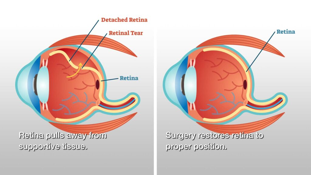 retina-treatment