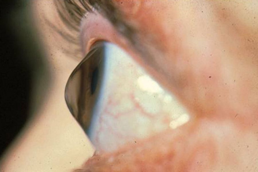wichita-corneal-disorder